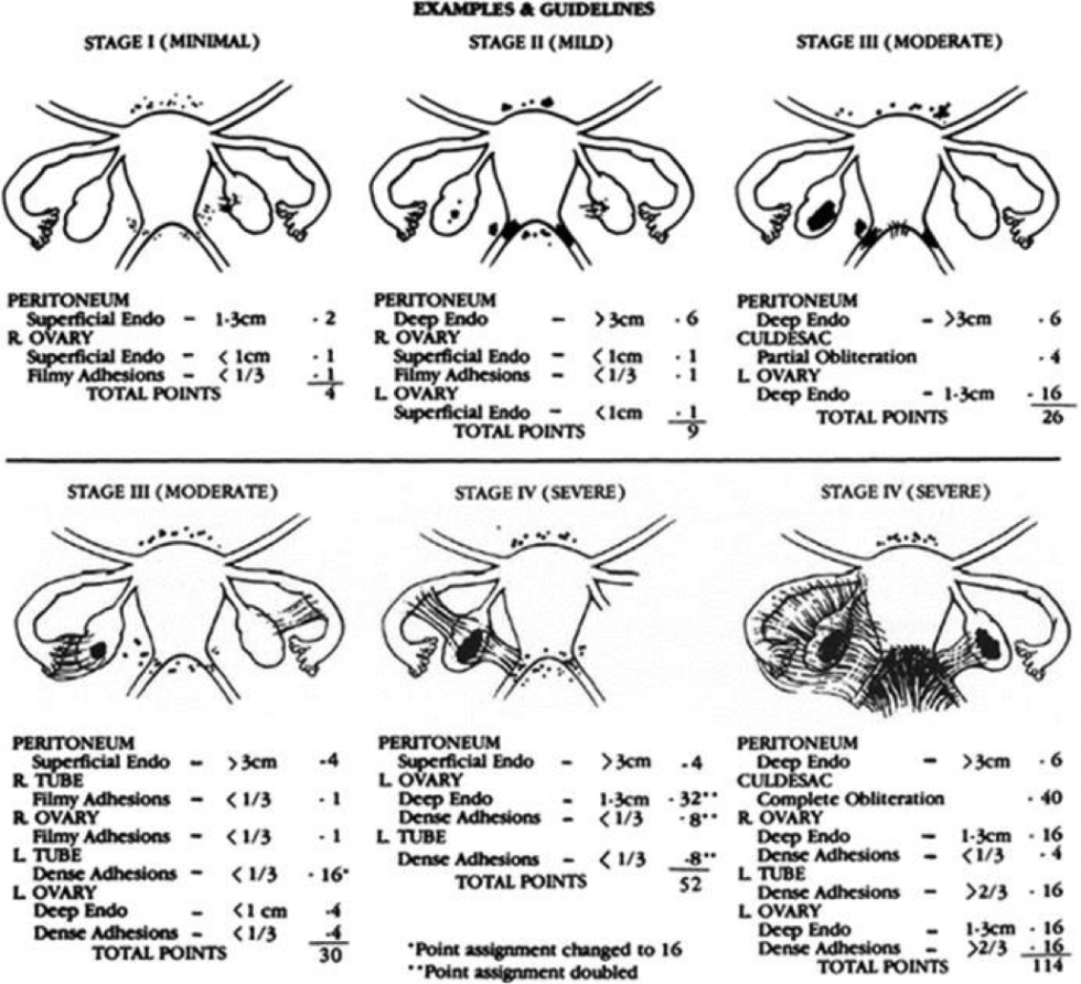 Endometriosis Chart