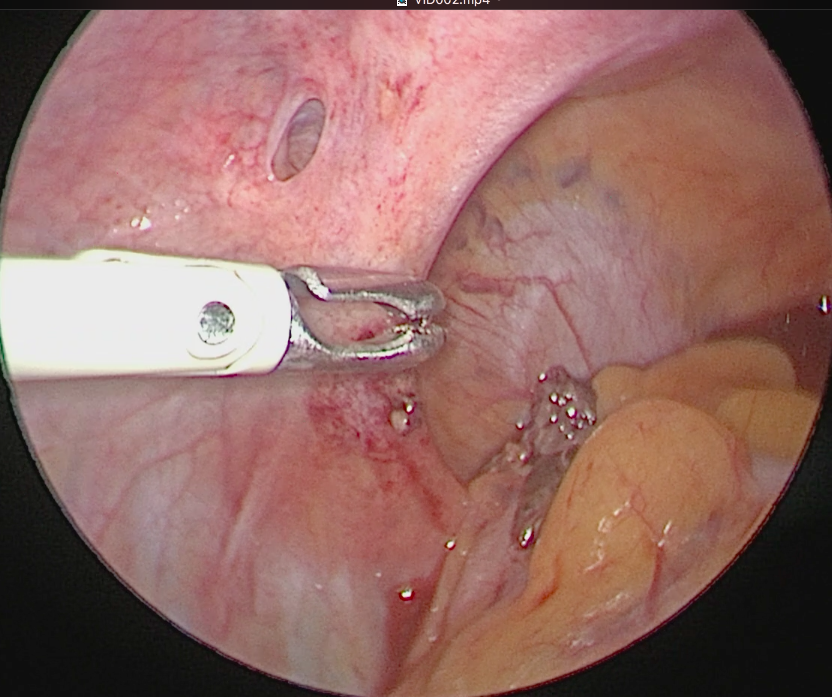 endométriose péritoine 